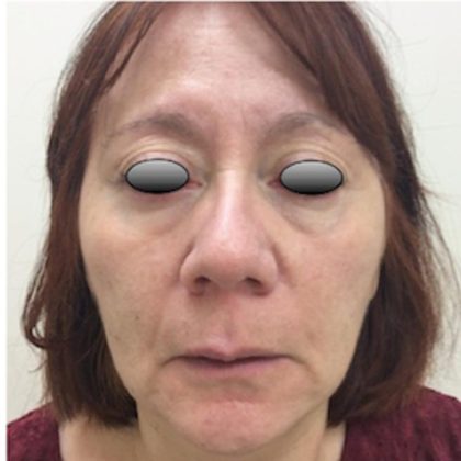 Fillers Before & After Patient #1011