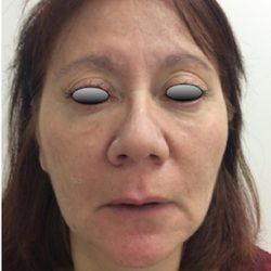 Fillers Before & After Patient #1011