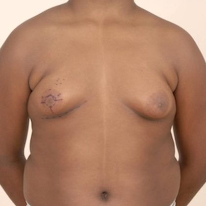 Gynecomastia Before & After Patient #1012