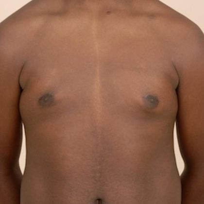 Gynecomastia Before & After Patient #1012