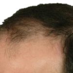 Hair Transplant Before & After Patient #1649