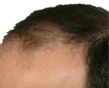 Hair Transplant Before & After Patient #1649