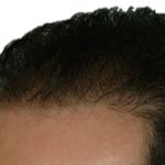 Hair Transplant Before & After Patient #1649