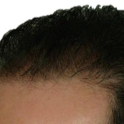 Hair Transplant Before & After Patient #1649