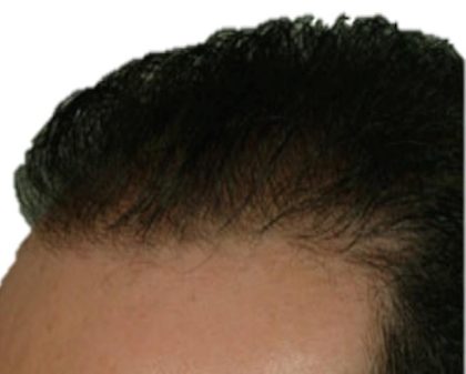 Hair Transplant Before & After Patient #1649