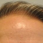 Hair Transplant Before & After Patient #1650