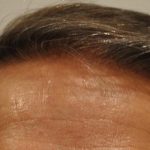 Hair Transplant Before & After Patient #1650
