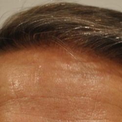 Hair Transplant Before & After Patient #1650