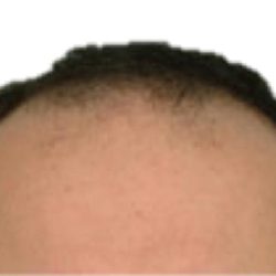 Hair Transplant Before & After Patient #1013