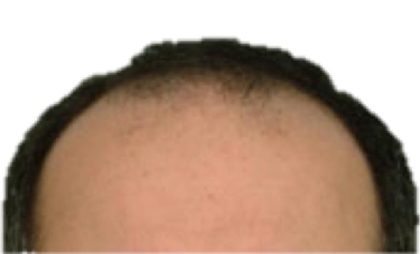 Hair Transplant Before & After Patient #1013