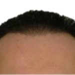 Hair Transplant Before & After Patient #1013