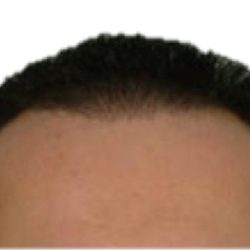 Hair Transplant Before & After Patient #1013