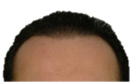Hair Transplant Before & After Patient #1013