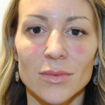 Injectable Fillers Before & After Patient #1623