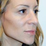Injectable Fillers Before & After Patient #1623