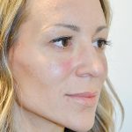 Injectable Fillers Before & After Patient #1623