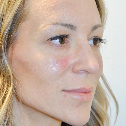 Injectable Fillers Before & After Patient #1623