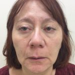 Injectable Fillers Before & After Patient #1621