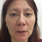 Injectable Fillers Before & After Patient #1621