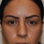 Injectable Fillers Before & After Patient #1014