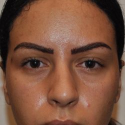 Injectable Fillers Before & After Patient #1014
