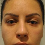 Injectable Fillers Before & After Patient #1014