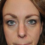 Injectable Fillers Before & After Patient #1015