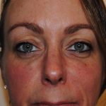 Injectable Fillers Before & After Patient #1015