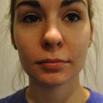 Injectable Fillers Before & After Patient #1016