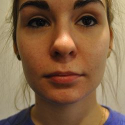 Injectable Fillers Before & After Patient #1016