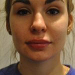 Injectable Fillers Before & After Patient #1016