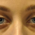 Injectable Fillers Before & After Patient #1017