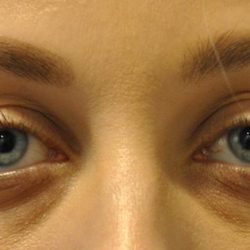 Injectable Fillers Before & After Patient #1017
