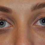Injectable Fillers Before & After Patient #1017