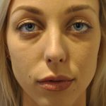 Injectable Fillers Before & After Patient #1017