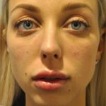 Injectable Fillers Before & After Patient #1017