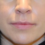 Injectable Fillers Before & After Patient #1018