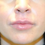 Injectable Fillers Before & After Patient #1018