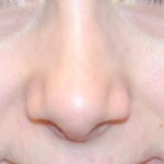 Injectable Fillers Before & After Patient #1019