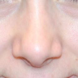Injectable Fillers Before & After Patient #1019