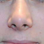Injectable Fillers Before & After Patient #1019