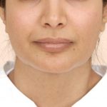 Mandibular Jaw Implants Before & After Patient #1020