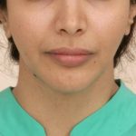 Mandibular Jaw Implants Before & After Patient #1020