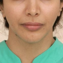 Mandibular Jaw Implants Before & After Patient #1020