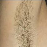 Laser Hair Removal Before & After Patient #1021
