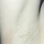 Laser Hair Removal Before & After Patient #1021