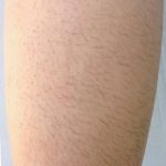 Laser Hair Removal Before & After Patient #1022