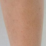 Laser Hair Removal Before & After Patient #1022