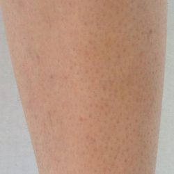 Laser Hair Removal Before & After Patient #1022