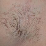 Laser Hair Removal Before & After Patient #1023